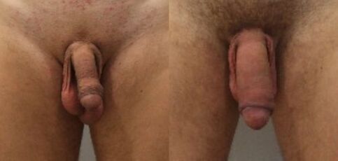 before and after penile enlargement surgery