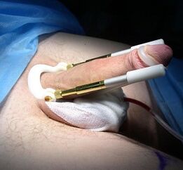 How the penis enlargement surgery is performed