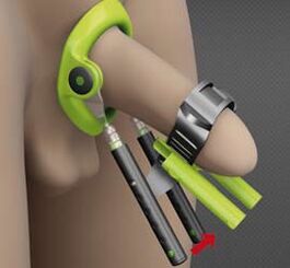 rehabilitation after surgery for penis enlargement